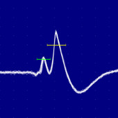 ELETROMIOGRAFIA DE FIBRA ÚNICA